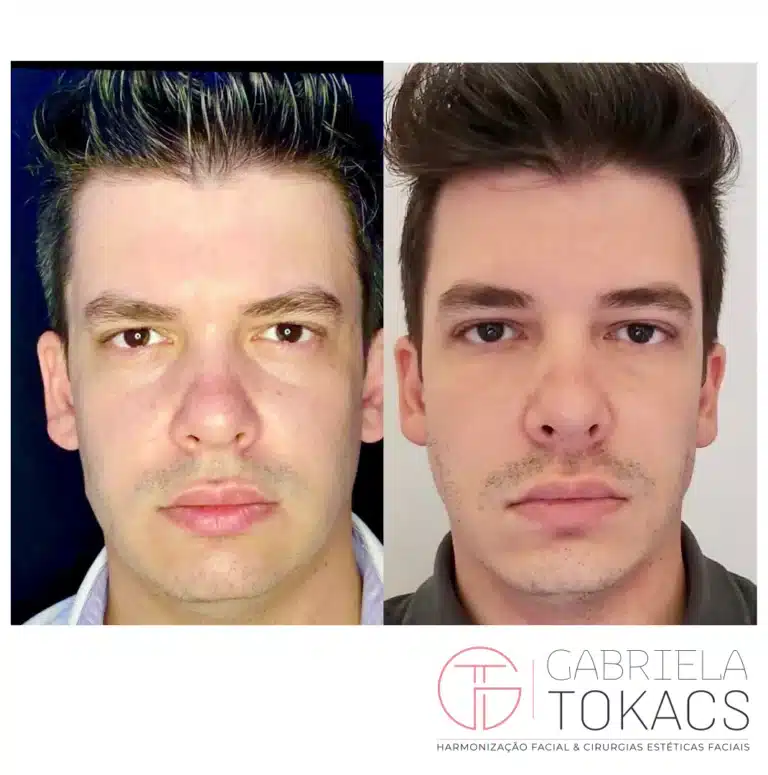 O resultado da Bichectomia apresentada acima é de 30 dias após a cirurgia, O resultado final acontece em aproximadamente de 6 a 12  meses.