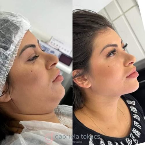 lipohd4
