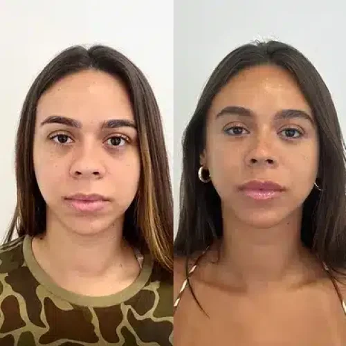olheira-labio